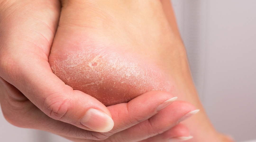 Causes And Treatment For Dry And Cracked Skin Advanced Foot And Ankle